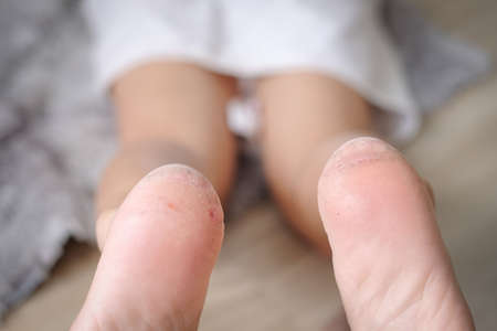 Close up cracked foot on floor.の写真素材