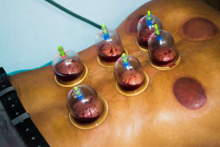 Acupuncture Treatmentの写真素材