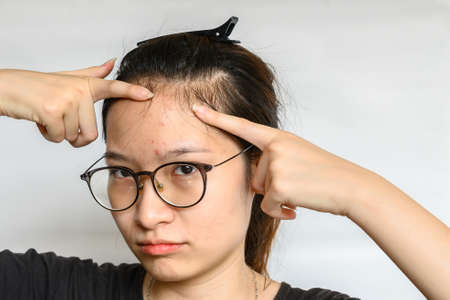 Portrait of woman trying to pointing problem of Acne and Scar from acne inflammation (Papule and...