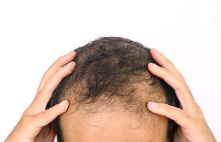 Close up of Male-pattern baldness with white copy-space, typically appears first at the hairline or top of the head. It can progress to partial or complete baldness.の写真素材