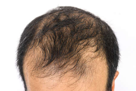 Close up of Male-pattern baldness typically appears first at the hairline or top of the head. It can...