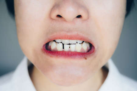 Close up of Asian woman open her mouth and showing her lower teeth not straight in a rows. Problem can solved by putting dental braces to encouraging them to move into the correct position.の写真素材