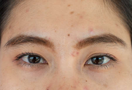 Close up of woman face with the problem of Acne and Scar from acne inflammation (Papule and Pustule) on her forehead. Conceptual of problems on woman skin.の写真素材