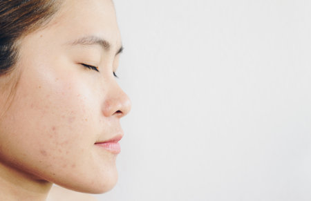 Half face of Asian woman has problems with skin on her face. Conceptual shot of problems with acne...