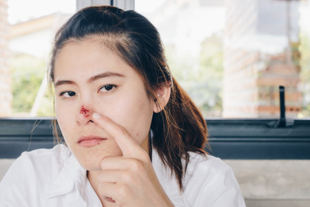 The Herpes simplex on asian woman nose, Herpes simplex is a viral disease caused by the herpes simplex virus. Infections are categorized based on the part of the body infected.の写真素材