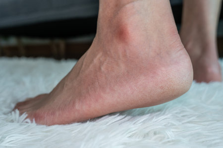 Cropped shot view of person foot with heel problem. Cracked heels occur when dry, thick skin on the bottom of your heels cracks and splits.の写真素材