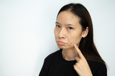 Serious Asian woman pointing to acne problems on her face. Inflamed acne consists of swelling, redness, and pores that are deeply clogged with bacteria, oil, and dead skin cells.の写真素材