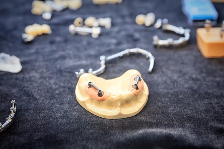 various samples of casts of dentures, close up