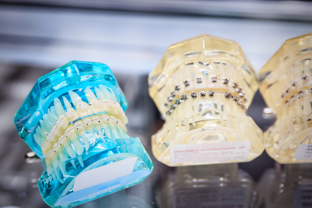 Samples of orthodontic braces on plastic models
