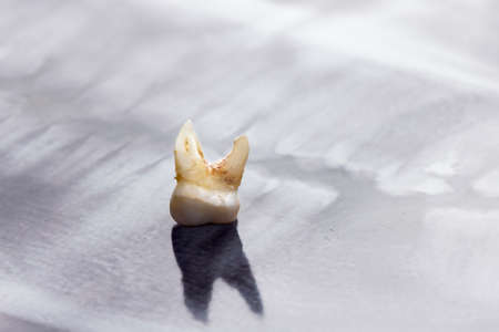 bad tooth and an X-ray picture of the problems in the jawの写真素材