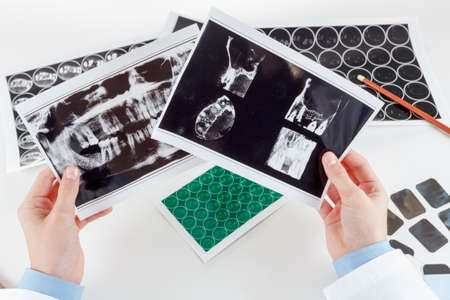 Panoramic x-ray jaw. A dentist holding an x-ray the patient's tooth and indicates the problemの写真素材