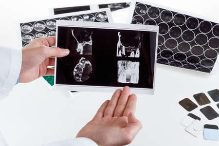 Panoramic x-ray jaw. A dentist holding an x-ray the patient's tooth and indicates the problem