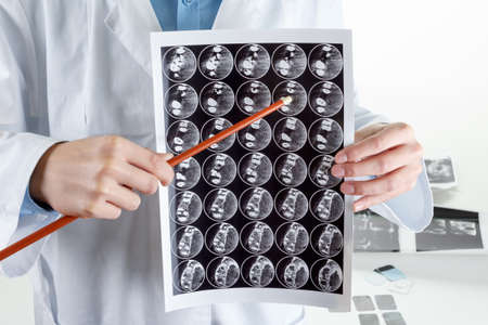 Panoramic x-ray jaw. A dentist holding an x-ray the patient's tooth and indicates the problem