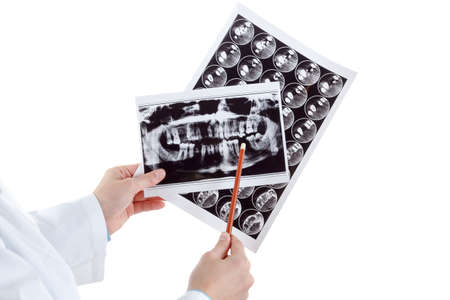 Panoramic x-ray jaw. A dentist holding an x-ray the patient's tooth and indicates the problem....