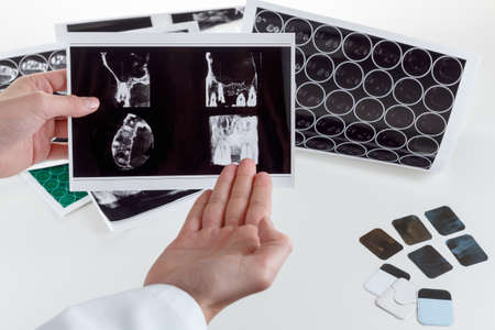 Panoramic x-ray jaw. A dentist holding an x-ray the patient's tooth and indicates the problemの写真素材