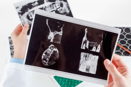 Panoramic x-ray jaw. A dentist holding an x-ray the patient's tooth and indicates the problemの写真素材