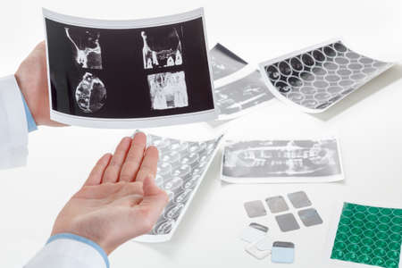 Panoramic x-ray jaw. A dentist holding an x-ray the patient's tooth and indicates the problem
