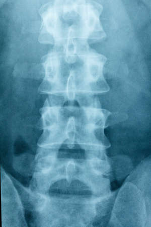 Scoliosis film x-ray lumbar spine AP, bones x-rayの写真素材