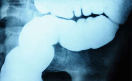 x ray of abdomen with contrast in large intestine.の写真素材