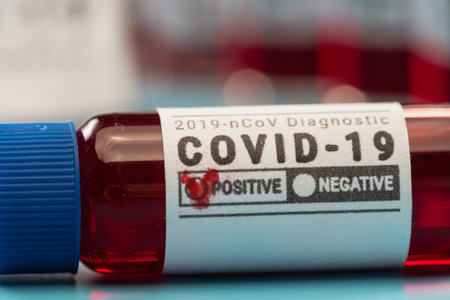 Virus disease lab covid-19, sample blood coronavirus, medical quarantine.