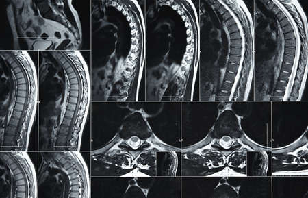 Close up magnetic resonance imaging or computed tomography scan of human lumbar spineの写真素材