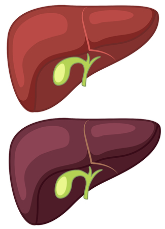 Healthy and Cirrhosis Liver illustrationのイラスト素材