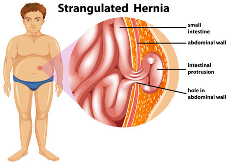 Man with strangulated hernia illustration