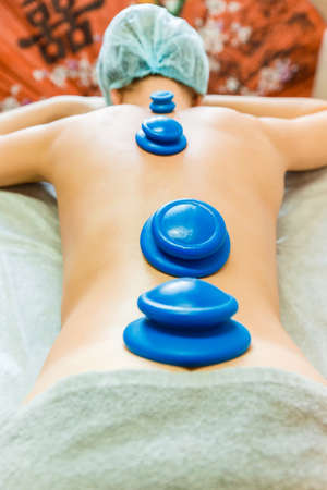 Close-up of vacuum jars on the girl's back.の写真素材