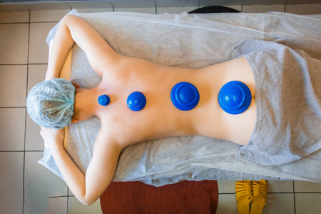 Close-up of vacuum jars on the girl's back.