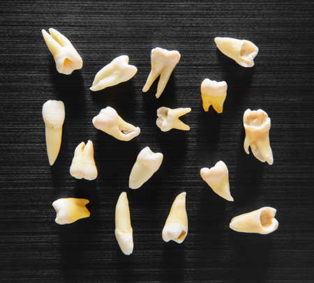 Extracted teeth with various defectsの写真素材