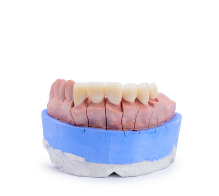 All ceramic highly aesthetic dental bridge and crown on gypsum model from labotary