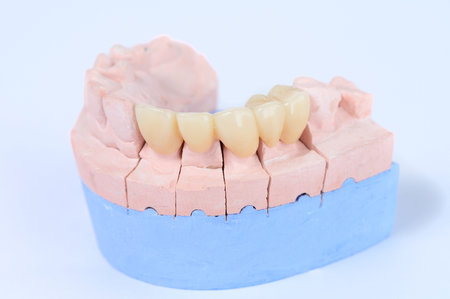 Ceramic tooth crown on plaster model