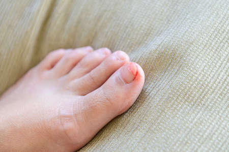 Damage to the nail plate on the legの写真素材