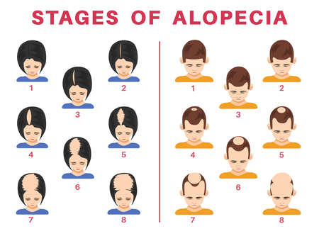 Stages of alopecia in men and women vector illustrations set. Tops of male and female heads with bald spots on scalps isolated on white background. Health, hair loss or treatment conceptのイラスト素材