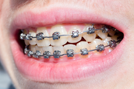 Mouth of boy with bracket teeth and lipsの写真素材