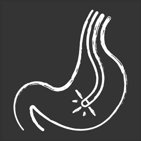 Endoscopy chalk icon. Gastroscopy process. Medical nonsurgical procedure. Healthcare services. Clinical treatment. Disease diagnostics. Visual inspection. Isolated vector chalkboard illustrationのイラスト素材