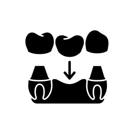 Dental prosthetics black glyph icon. Implant design. Silhouette symbol on white space. Instruments for dental treatment. Contemporary dental treatment. Vector isolated illustrationのイラスト素材