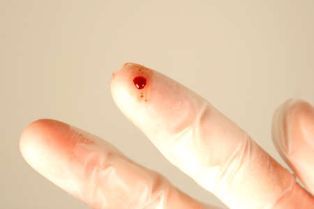 Needle Stick Injury