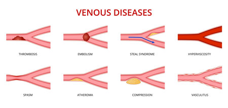 Human vein disease, venous disorders vector set. Thrombosis, embolism, steal syndrome, hyperviscosity, spasm, atheroma, compression and vasculitis. Health care or educational and medical infographicsのイラスト素材