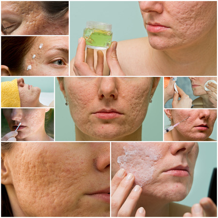 Collage of acne treatment and acne scars on female faceの写真素材