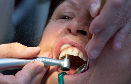 Close up of dentist's hands and equipment working on mature woman's teethの写真素材