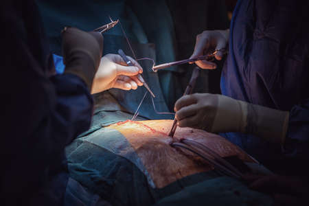 Medical team of surgeons in hospital doing minimal invasive surgical interventions. Surgery operating room with electrocautery equipment for cardiovascular emergency surgery center.の写真素材