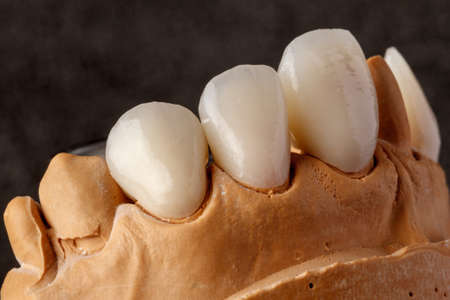 Dental implant. Restoration of teeth. Dental surgeon. Dental laboratory. Dental clinic. Implants of the jaw of a person. Visual materials at the dentist's office. Oral health.の写真素材