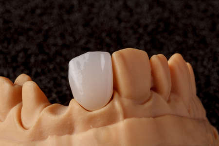 Dental implant. Restoration of teeth. Dental surgeon. Dental laboratory. Dental clinic. Implants of...