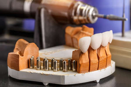 Dental implant. Restoration of teeth. Dental surgeon. Dental laboratory. Dental clinic. Implants of...