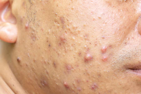 Close up photo of nodular cystic acne blemish spots skin on man faceの写真素材