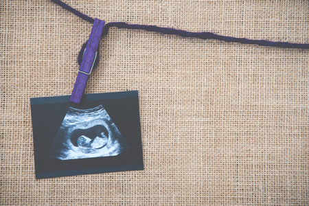 Medical images collage of ultrasound during woman pregnancy showing fetus in third month and stetoscope on white backgroundの写真素材