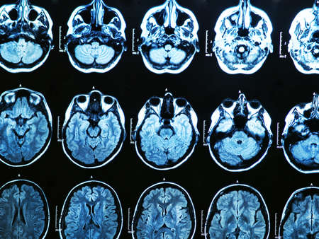 MRI scan of the human brainの写真素材