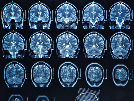 MRI scan of the human brainの写真素材