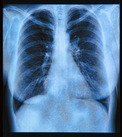 X-Ray image if the human chestの写真素材